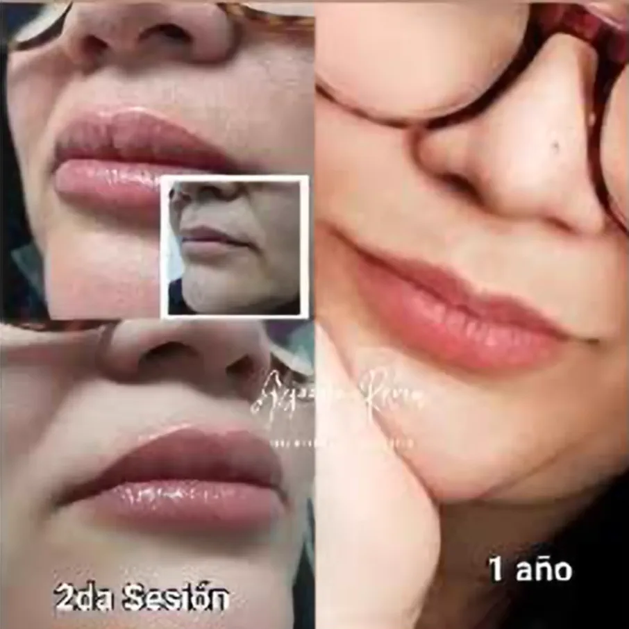 Evolución de una micropigmentación de labios: segunda sesión y resultado un año después